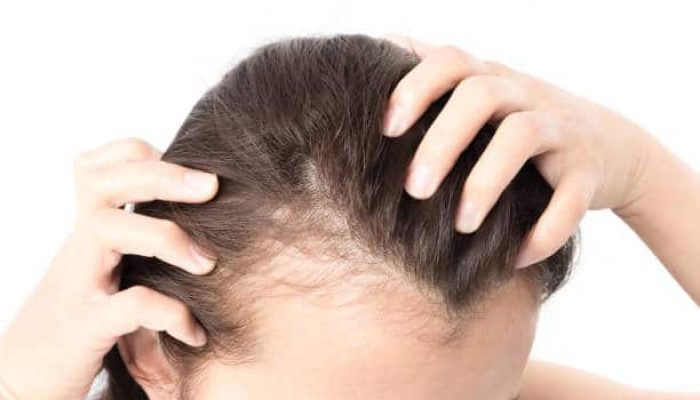 Everything You Need To Know About Hair Loss