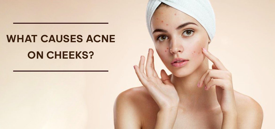 What causes acne on cheeks