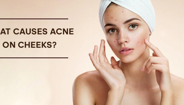 How Much Do You Know about What Causes Acne On Cheeks?